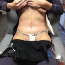2 Days Post Op. When I first saw, I didn't even notice my scar....I was just so happy that my tummy was flat again!