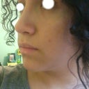 2 months and four days after surgery. Left side.