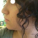 2 months and four days after surgery. Left Profile.