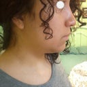 2 months and four days after surgery. Left Profile.