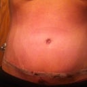 1 week post op. Still in recovery mode but 100% glad I had this done.