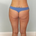 2-weeks post op