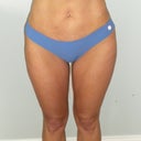 2-weeks post op