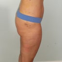 2-weeks post op