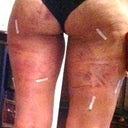 Taken the day after my procedure (6/16/12).  Just starting to bruise.