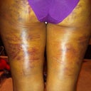 Taken on 6/20/12.  Significant bruising, swelling and pain (mixed with numbness) which made me cranky at work...which led to me trying Kinesio Tape on 6/21/12!!!!