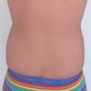 Love handles/flanks one day prior surgery.