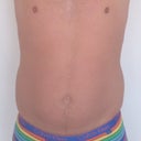 One day prior surgery.
