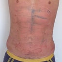 One day post surgery.