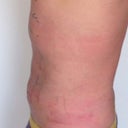 One day post surgery.