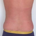 Love handles/flanks one day post surgery.