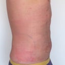 One day post surgery.