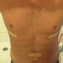 Two days post surgery.