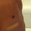 Two days post surgery. Abdominal definition clearly visible.
