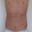 Three days post surgery.