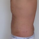 Three days post surgery.