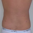 Love handles/flanks three days post surgery.