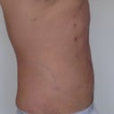 Three days post surgery.
