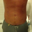 Six days post surgery. Had my stitches taken out today.