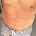 Seven days post surgery.
