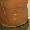 Applying natural homeopathic healing cream to incision sights.