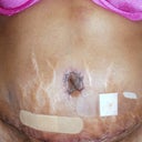 11 days PO front view, still so much stretch marks, IDK