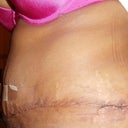 11days PO side view