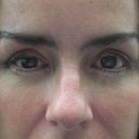 Up close of 4 lid bleph surgery 4 weeks post op - uneven and slanted