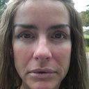 After four lid bleph and facial fat surgery at 4 weeks