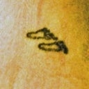 Tattoo Removal 