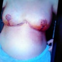 8 days watch in purple spot left under nipple