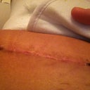 scar almost 3 weeks PO...so impressed