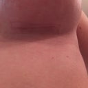Lefty Day 21.The scars look better in person.
