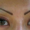 6 months post op, 2 weeks after lasering upper lid skin to tighten
