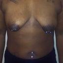 pre-op front pic