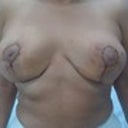 Day 4 Post Op