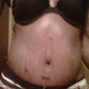 scar below my tummy is from my lapand