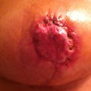 Almost 1 month post-op.  Close up of right nipple/areola after necrotic tissue removal one week ago.  PS says it is healing "nicely".