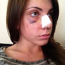 3 days post op. still pretty swollen, but feeling fine. :)