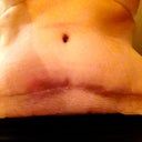 5 weeks PO - see the lower red area in the shadow left by my arm