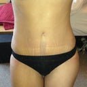 4 weeks post op