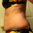 Before pictures.  The bathing suit bottom was tighter than what I normally wear and I had lost about 5 lbs before the procedure