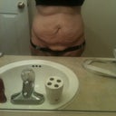 Day before surgery, front: wondering what 115 pounds of weight loss can do? Well here ya go! I don't recommend the weight gaining part.