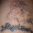 2months after 3 rd treatment