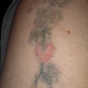 2 months after 3rd treatment