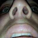 Nose 1 wk