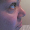 Nose 3 months