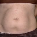 Front shot before lipodissolve
