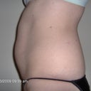 Side shot after session 2 of lipodissolve