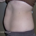 Side shot before lipodissolve